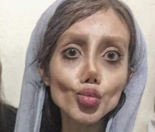 Lakukan Operasi Plastik 50 Kali Demi Mirip Angelina Jolie, Tapi Wajah Remaja Ini Malah Mirip Zombie! Dafunda 