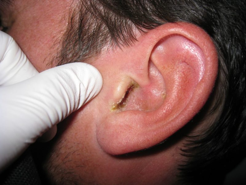 Otitis Externa Min