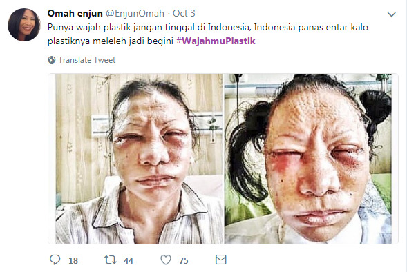 Ratna Sarumpaet Viral, Netizen Ramai Ramai Bikin Tagar #Wajahmuplastik Oplas