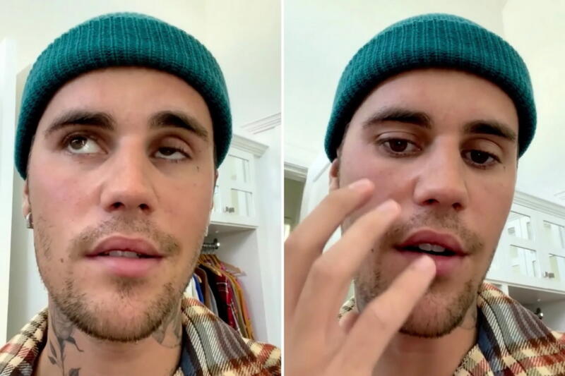 justin bieber lumpuh sebelah